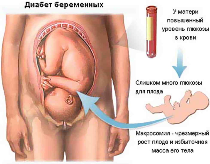 Повышенная глюкоза в крови при беременности