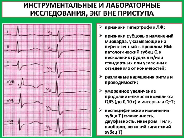 Рубец на сердце после инфаркта фото