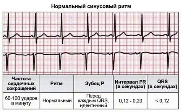 Синусовая аритмия у ребенка 5-6 лет