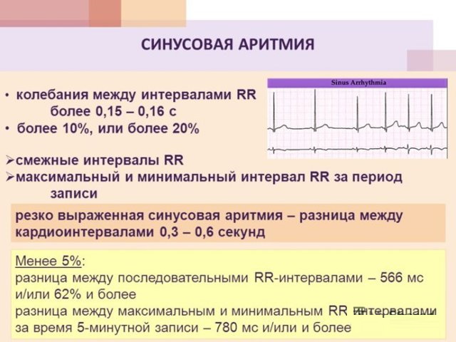 Синусовая аритмия у ребенка 5-6 лет