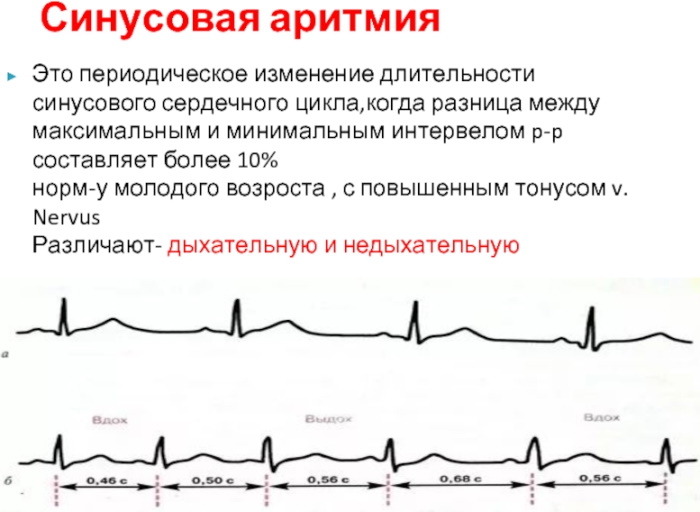 Синусовая аритмия у ребенка 5-6 лет