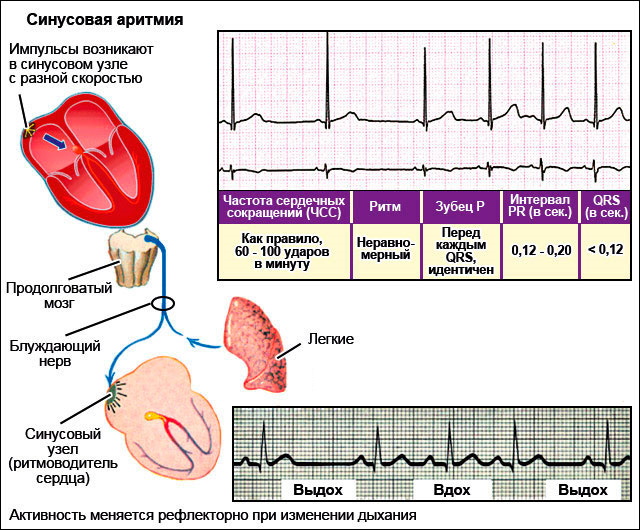 Синусовая аритмия у ребенка 5-6 лет