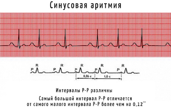 Аритмия сердца. Симптомы, лечение, первая помощь