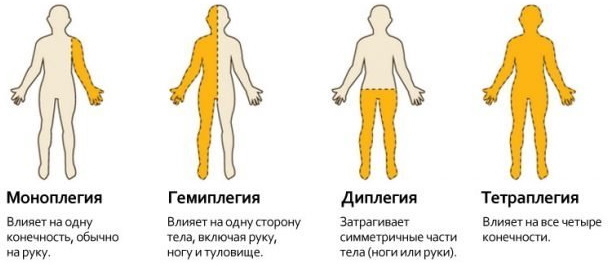 Спастический тетрапарез у детей. Что это такое, причины и лечение