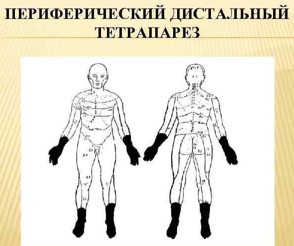 Спастический тетрапарез у детей. Что это такое, причины и лечение