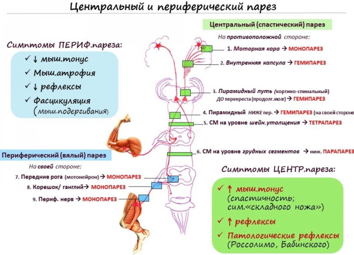 Спастический тетрапарез у детей. Что это такое, причины и лечение