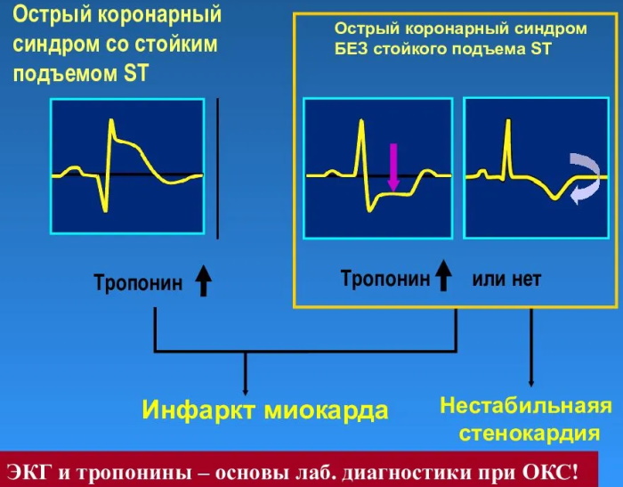 Стенокардия сердца у женщин. Симптомы и лечение