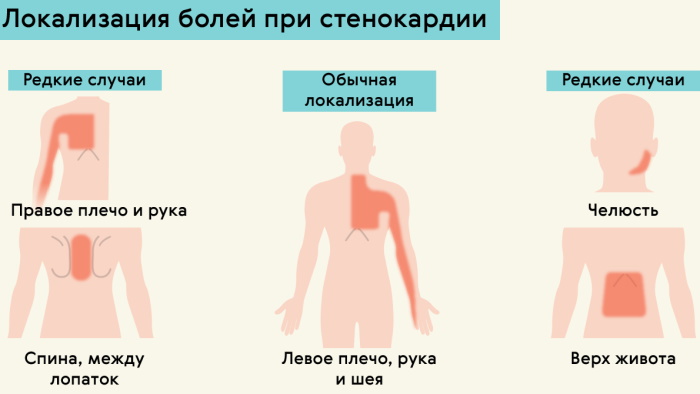 Стенокардия сердца у женщин. Симптомы и лечение