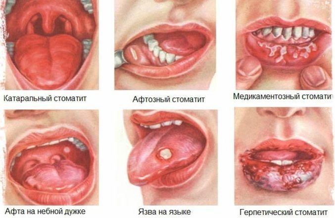 Стоматит на десне. Мази, лечение детей, взрослых