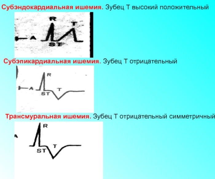 Субэндокардиальная ишемия на экг фото