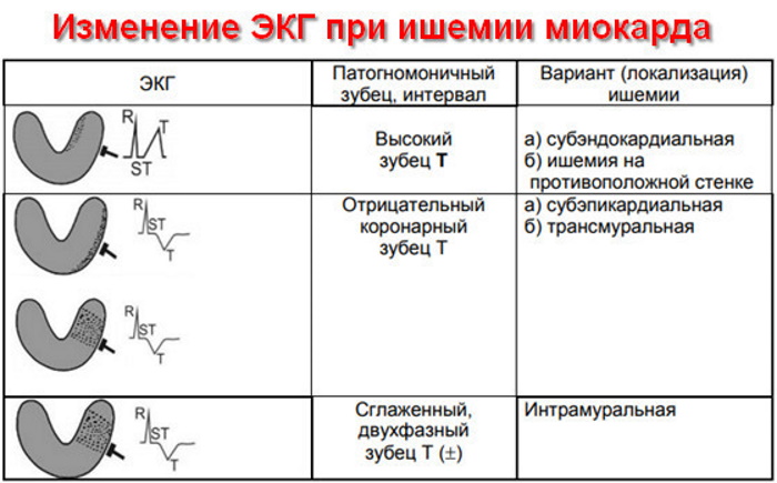 Критерии ишемии