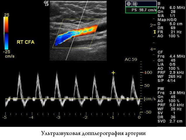 ЦДС сосудов нижних конечностей. Что это такое