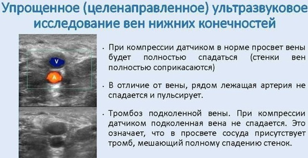 ЦДС сосудов нижних конечностей. Что это такое