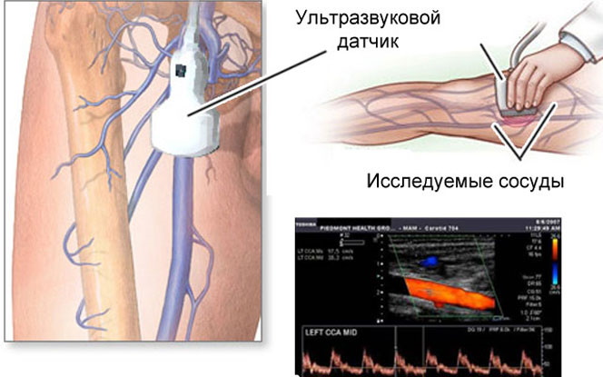 ЦДС сосудов нижних конечностей. Что это такое