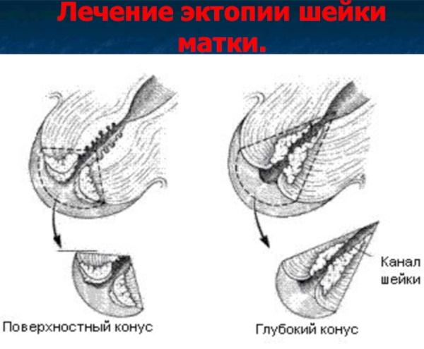 Цервикальная эктопия при хроническом цервиците