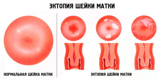 Цервикальная эктопия при хроническом цервиците