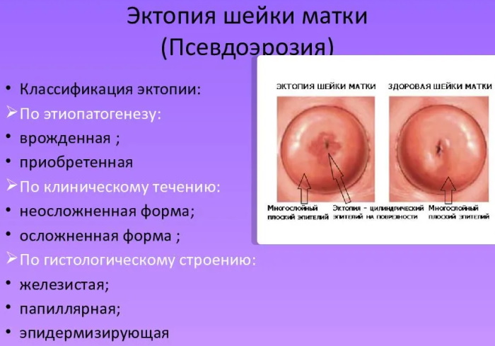 Цервикальная эктопия при хроническом цервиците