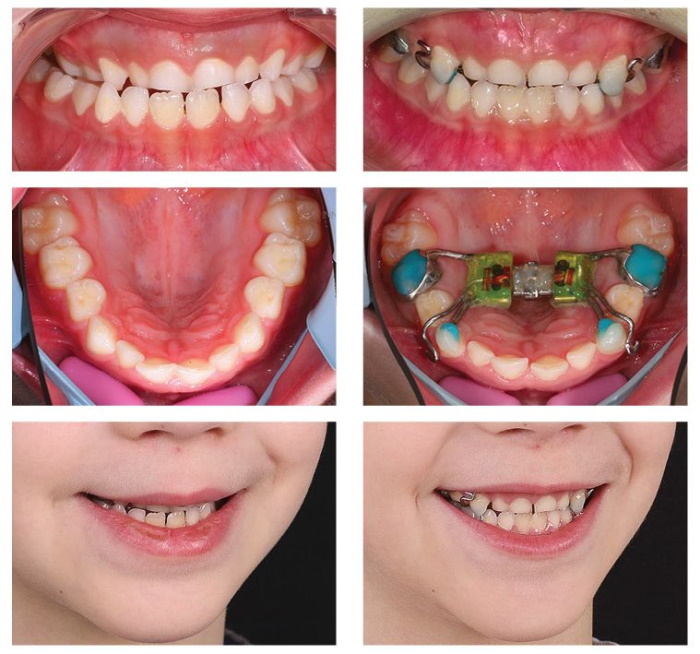 Аппарат для расширения челюсти для детей