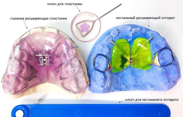 Аппарат для расширения челюсти для детей