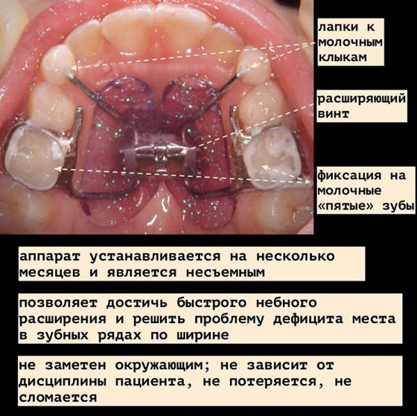 Аппарат для расширения челюсти для детей