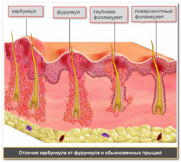 Чирей на ноге. Как лечить мазью, можно ли купаться