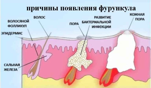 Чирей на ноге. Как лечить мазью, можно ли купаться