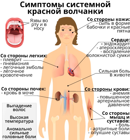 Дискоидная красная волчанка. Фото, диф.диагностика