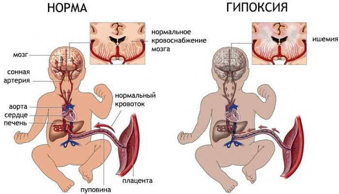 Дистресс плода при родах. Что это, последствия