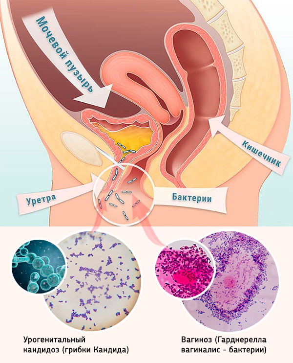 Дрожжевые грибы в мазке у женщин. Лечение, что это такое