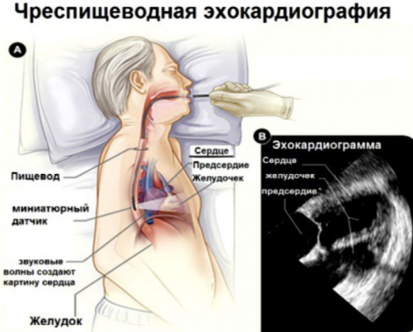 Эхокардиографии сердца у взрослых. Расшифровка, норма, таблица