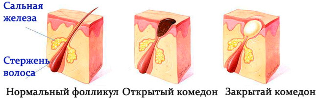 Как убрать угри в ушах: как выдавливать, мази, народные средства