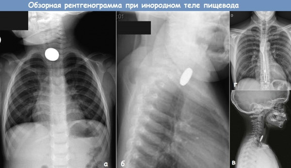 Как вызвать рвотный рефлекс после еды у человека