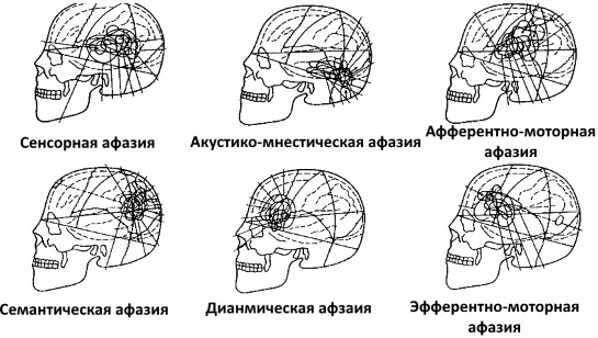 Классификация речевых нарушений: психолого, клинико педагогическая. Причины, виды