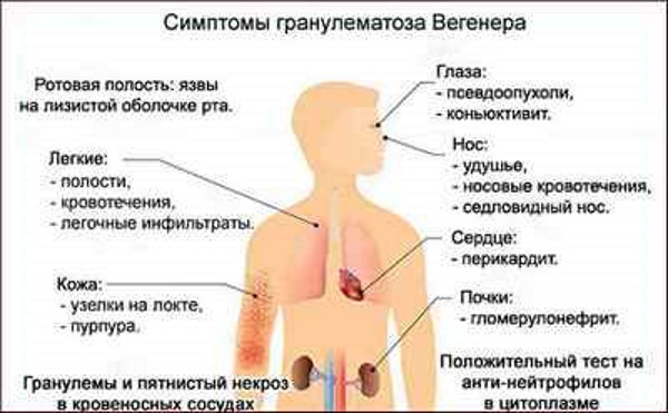 MID в анализе крови повышен у ребенка, женщин, мужчин