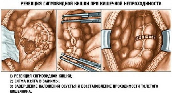 Острый живот в хирургии. Симптомы заболевания, клинические рекомендации