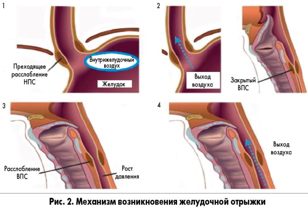 Отрыжка воздухом без запаха постоянно. Причины и лечение