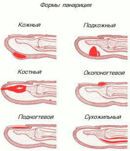 Панариций пальца на ноге. Симптомы и лечение