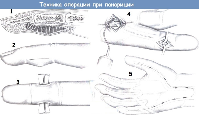 Панариций пальца на ноге. Симптомы и лечение