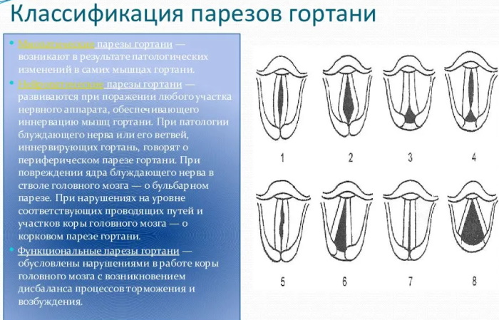 Рак голосовых связок фото