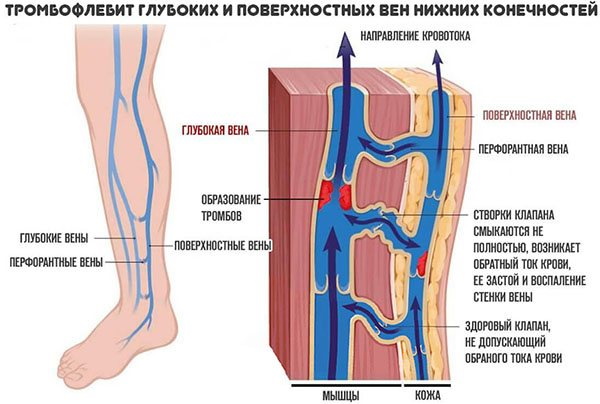 Перфорантные вены нижних конечностей. Это что такое, анатомия