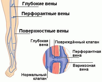 Перфорантные вены нижних конечностей. Это что такое, анатомия