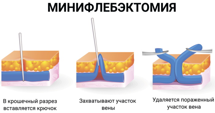 Перфорантные вены нижних конечностей. Это что такое, анатомия