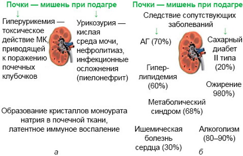 Подагра на ногах. Фото, лечение, таблетки, народные методы