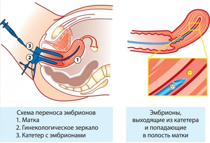 Подготовка к криопереносу эмбрионов в естественном цикле