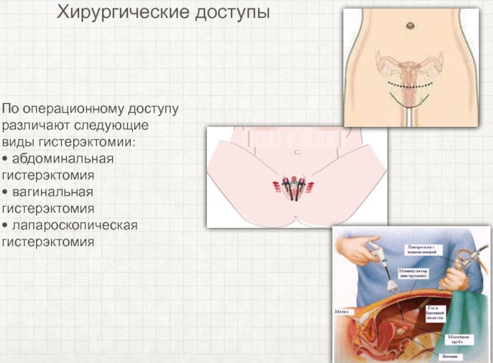 Подготовка к операции по удалению матки и яичников