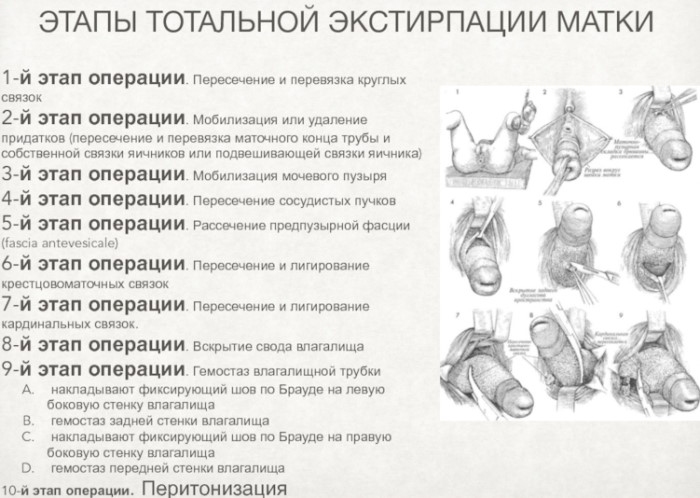 Подготовка к операции по удалению матки и яичников