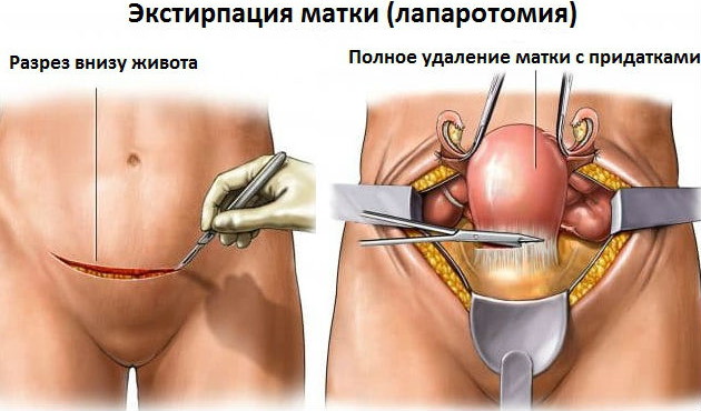 Подготовка к операции по удалению матки и яичников