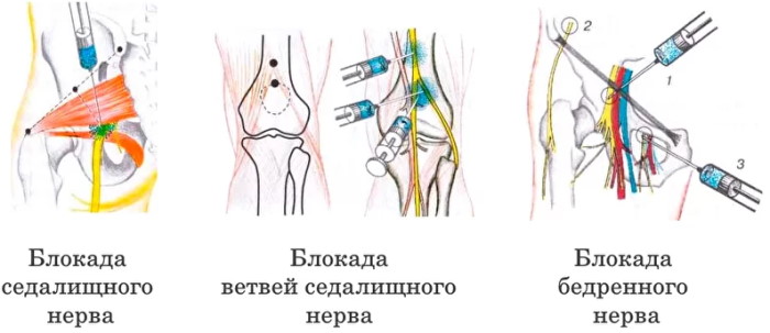 Портняжная мышца. Где находится, фото, функции