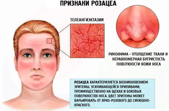 Розацеа у женщин. Что это, схема лечения, питание