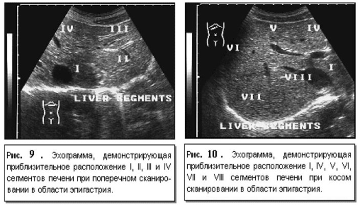 Сегменты печени на УЗИ, КТ, МРТ срезах. Схема, фото